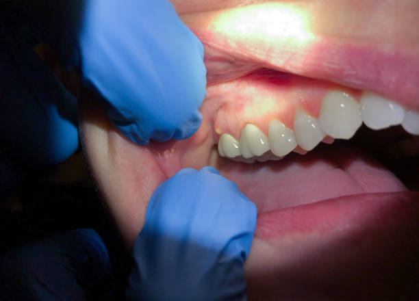 Best Emergency Broken Tooth Repair in Grand Blanc, MI